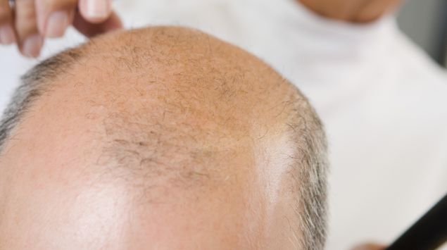 Das Bild zeigt einen Mann mit Glatze beim Friseur.