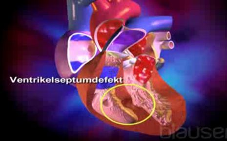 Angeborener Herzfehler Video