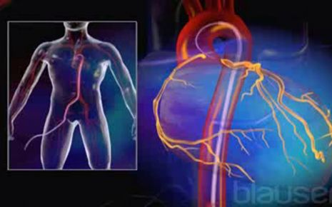 Angiogramm Video