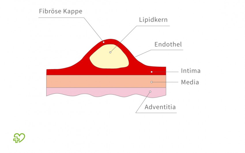 Das Bild zeigt den schematischen Aufbau einer fortgeschrittenen arteriosklerotischen Plaques.
