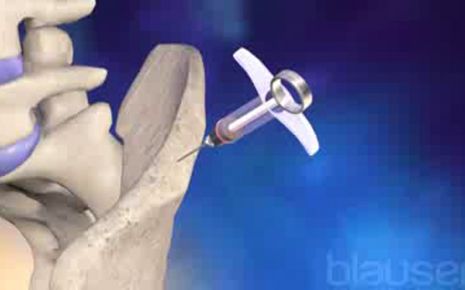 Autologe Stammzelltransplantation Video