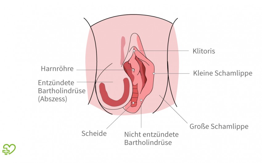 Das Bild zeigt einen Abszess an der Bartholin-Drüse.
