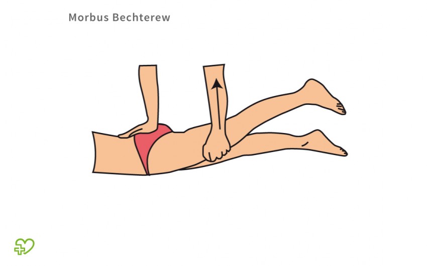 Diagnose bei Morbus Bechterew: Der Arzt hält das Kreuzbein mit der Handfläche fest und bewegt das Becken durch Überstreckung gegenüber dem Kreuzbein im Iliosakralgelenk.