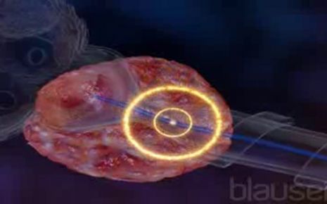 Brachytherapie Video