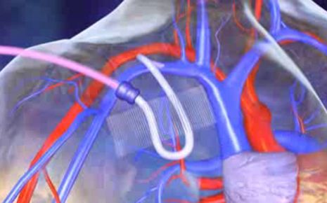 Chemotherapie Video