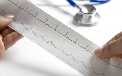 Das Bild zeigt den Ausschnitt eines EKGs.