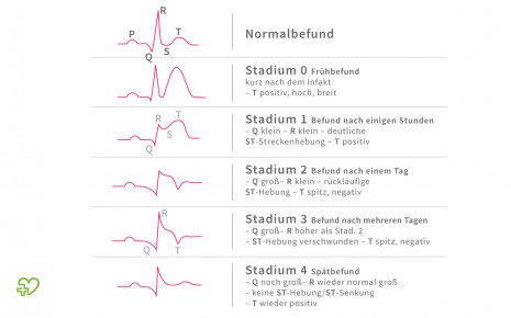 Eine schematische Darstellung eines EKGs.