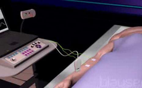 Elektromyographie, Video