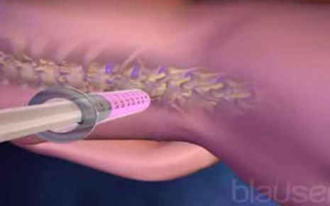 Epiduralanästhesie Video