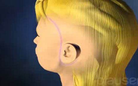 Facelift Video
