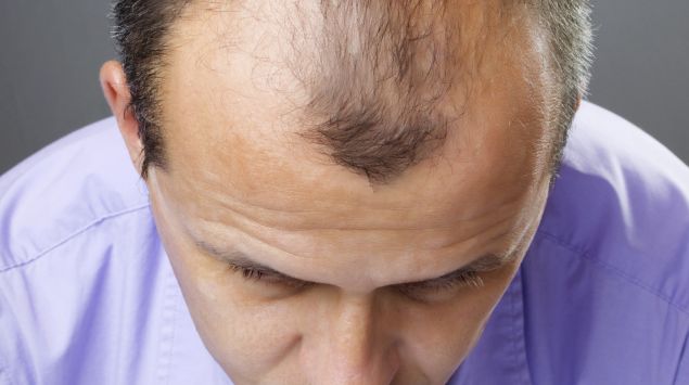 Kopf eines Mannes mit Haarausfall von oben betrachtet