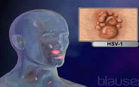 behandlung herpes genitalis