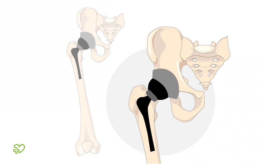Bei einer Totalendoprothese ersetzt der Arzt sowohl die Hüftpfanne als auch den Oberschenkelkopf durch künstliche Implantate.
