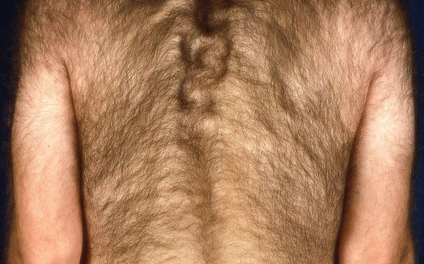 Man sieht einen Mann mit Hypertrichose.
