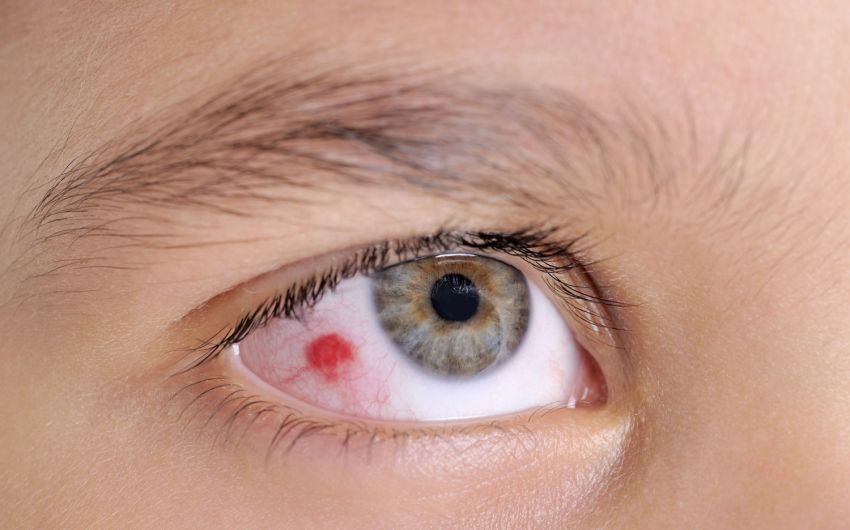 Rote Augen Gerotete Augen Ursachen Therapie Onmeda De