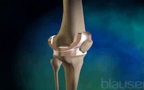 Knieprothese Video