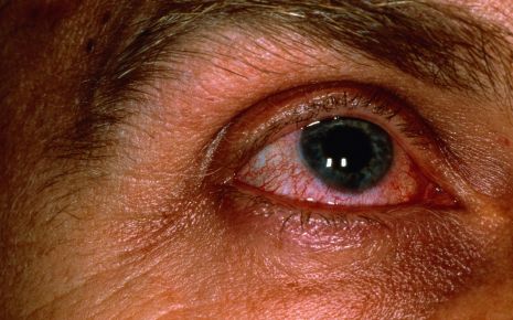 Rote Augen Gerotete Augen Ursachen Therapie Onmeda De