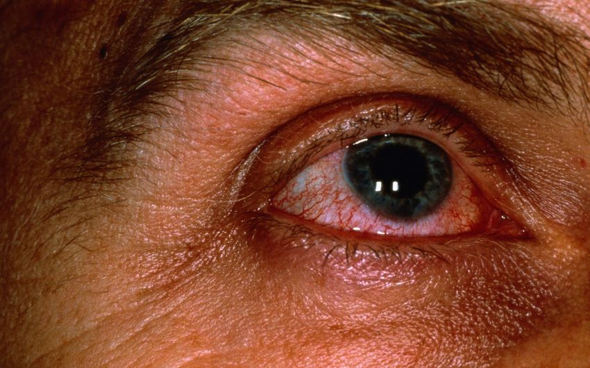 Rote Augen Gerotete Augen Ursachen Therapie Onmeda De