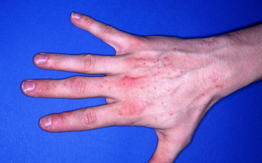 Ein Kontaktekzem auf einer Hand.