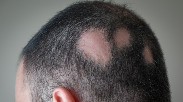 Das Bild zeigt den Kopf eines Mannes, der unter Haarausfall leidet.