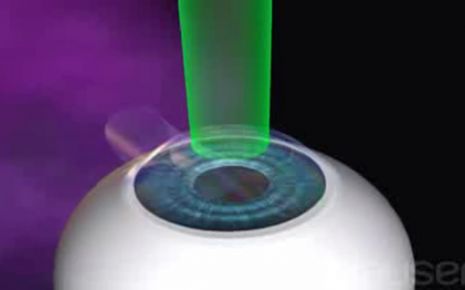 LASIK Augenchirurgie Video