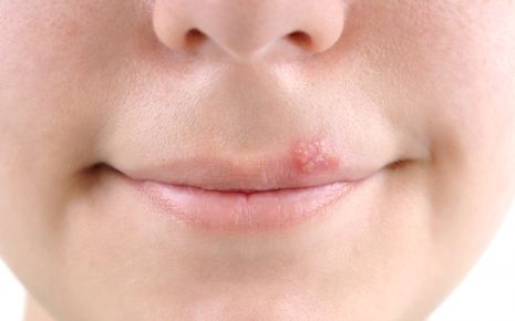Das Bild zeigt einen Lippenherpes.