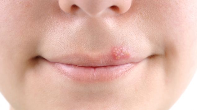 Lippenherpes Herpes Labialis Vorbeugen Behandeln Onmeda De