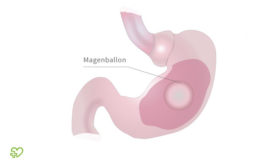 Magenballon