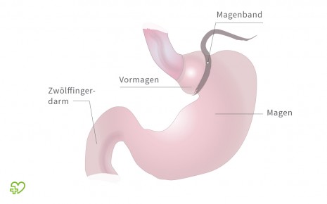 Illustration: Magenband