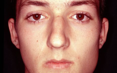 Man sieht einen jungen Mann mit Mumps.