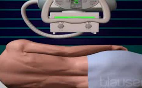 Myelographie Video