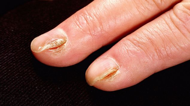 Nagelpilz Erkennen Und Behandeln Onmeda De