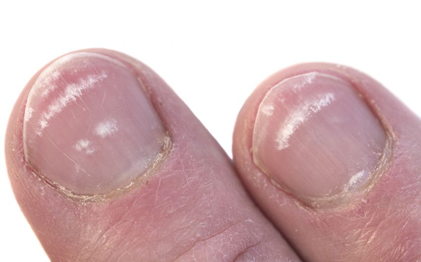 Nagelverfarbungen Ursachen Behandlung Onmeda De