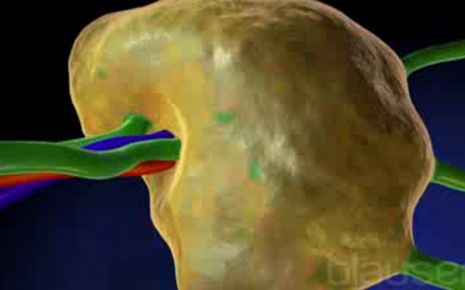 Non-Hodgkin-Lymphom Video