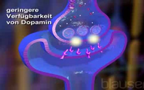 Parkinson Video