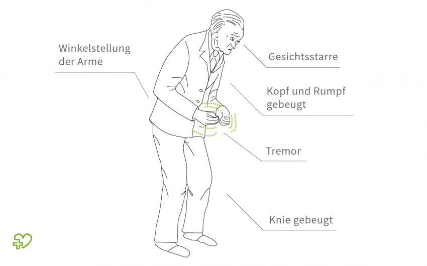 Morbus Parkinson Symptome Verlauf Lebenserwartung - 