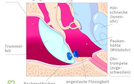 Graphische Darstellung eines Paukenröhrchens im Ohr.
