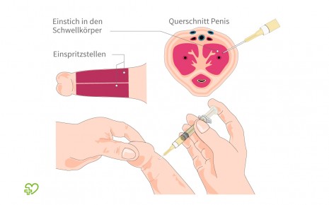 implantat mannlichen penis