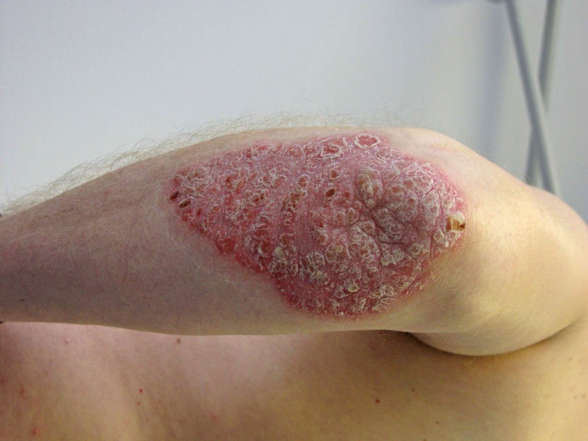 psoriasisarm-850x638.jpg