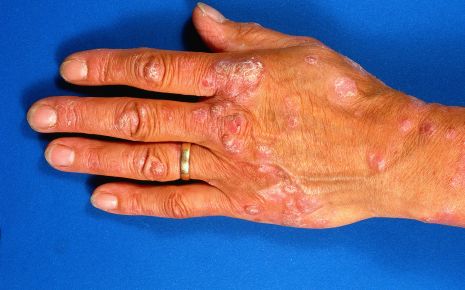 Eine Hand mit Schuppenflechte.