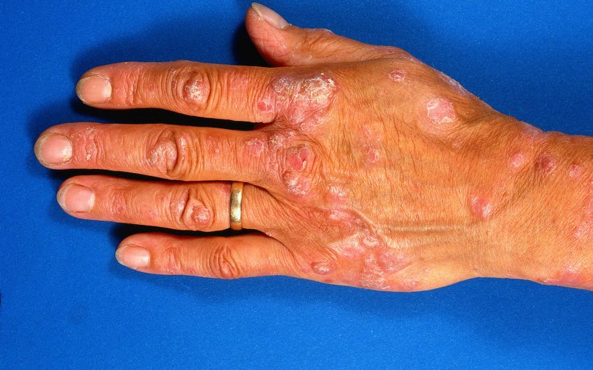 Eine Hand mit Schuppenflechte.