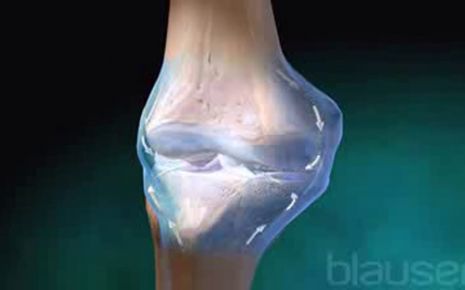 Rheumatische Arthritis Video