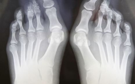 Röntgenbild von Füßen mit Hallux valgus.