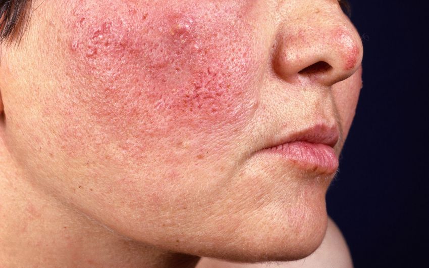 Rosacea Symptome Behandlung Pflege Tipps Onmeda De