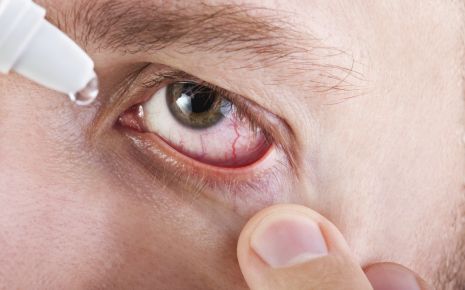 Rote Augen Gerotete Augen Ursachen Therapie Onmeda De