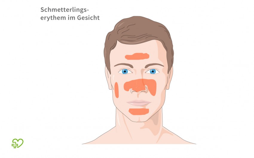 Typisch für SLE: Eine schematische Darstellung eines Schmetterlingserythems im Gesicht.