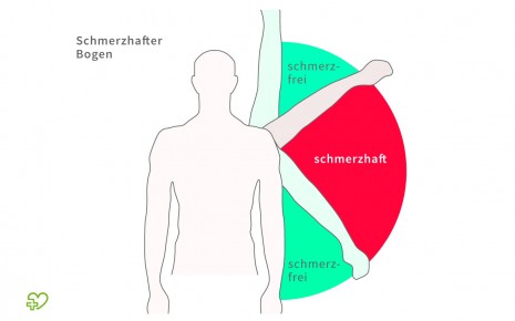 Darstellung des schmerzhaften Bogens beim seitlichen Anheben des Arms