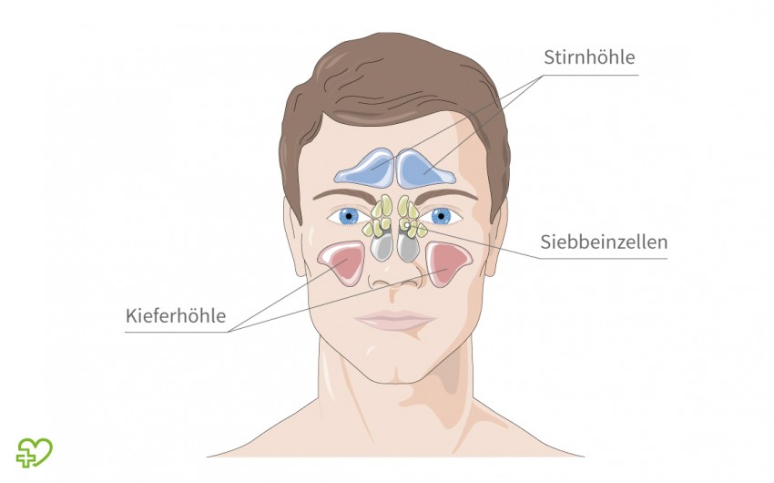 Nasennebenhohlenentzundung Sinusitis Symptome Hausmittel Medikamente Dauer Onmeda De