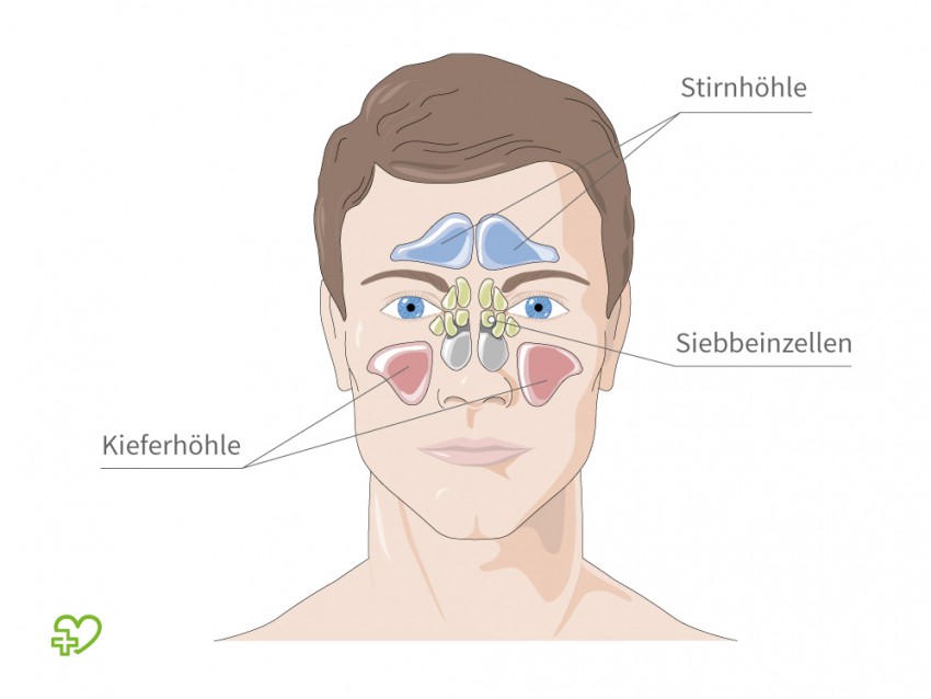Entzündung Nasennebenhöhlen Symptome Entzündung Nasennebenhöhlen Symptome