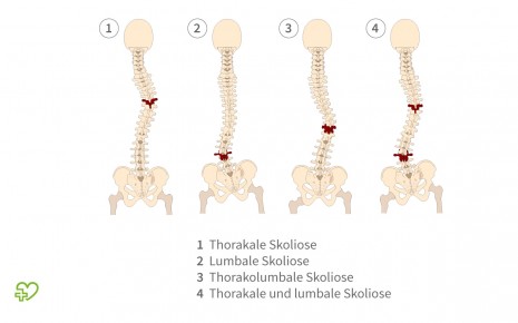 Skoliose Ursachen Therapie Onmeda De